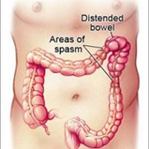 Drug Effects Side Zelnorm - What Is Irritable Bowel Syndrome (IBS)?